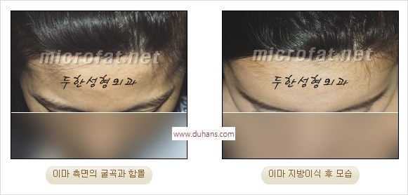 [두한성형외과 경쟁력 동안성형 리더] - ​[미간주름, 이마주름, 안검성형, 이마거상술, 눈썹거상술] 관련 이미지 32