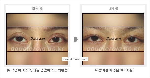 ​[두한성형외과 쌍꺼풀 재수술] - [푸는 수술을 하고 내원했을 경우의 문제] 관련 이미지 4