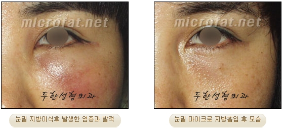 [Duhan Plastic Surgery Liposuction] - [Facial Liposuction] image 15