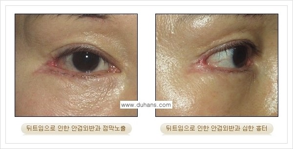 [두한성형외과 경쟁력 있는 쌍꺼풀 재수술] - [뒤트임 수술] 관련 이미지 9