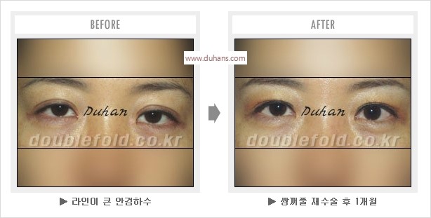 [두한성형외과 경쟁력 눈성형] - [나에게 맞는 어울리는 쌍꺼풀 라인] 관련 이미지 27