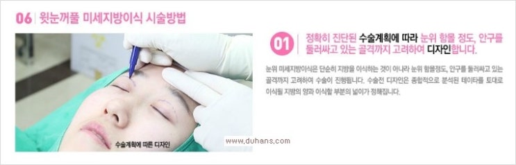 [두한성형외과 경쟁력 다크써클 치료] - [다크써클 + 눈위 지방이식 콤비 프로그램] 관련 이미지 6