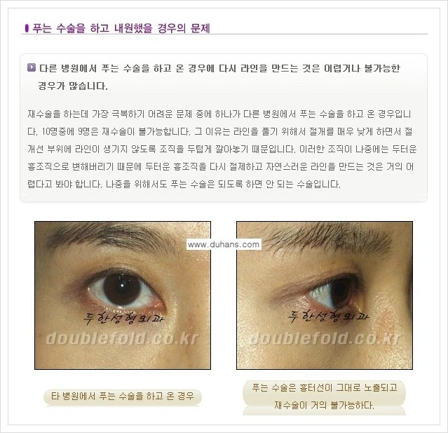 [두한성형외과 경쟁력 쌍꺼풀 재수술, 극한 재수술] - [재수술에서 극복해야 할 극한의 상황과 문제들 안내] 관련 이미지 10