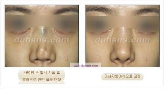 [두한성형외과 경쟁력 코성형] - [코를 높히는 지방이식] 관련 이미지 14
