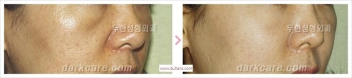 [두한성형외과 경쟁력 멀티성형] - [다크써클과 인디언밴드와의 관계] 관련 이미지 11