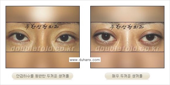 쌍꺼풀 재수술 Dr. 컬럼 관련 이미지 1