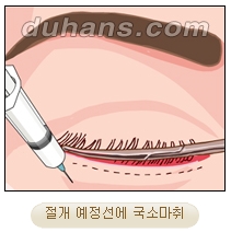 [두한성형외과 안검성형] - [상안검, 하안검] 관련 이미지 16