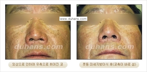 [두한성형외과 경쟁력 미세지방이식] - [코 지방이식 2.] 관련 이미지 5