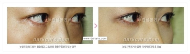 [두한성형외과 경쟁력 다크써클 교정] - [다양한 다크써클 증상 안내 2.] 관련 이미지 3