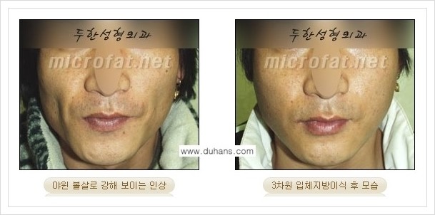 [두한성형외과 경쟁력 볼살지방이식] - [사각턱의 경우, 측면 볼살의 함몰선, 안면비대칭, 남성 야윈볼살 안내] 관련 이미지 14