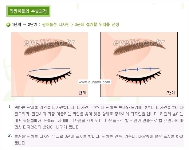 [두한성형외과 경쟁력 눈성형] - [퀵쌍꺼풀(부분절개법) 수술 안내] 관련 이미지 12