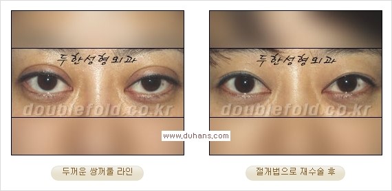 [두한성형외과 경쟁력 쌍꺼풀 재수술] - [쌍꺼풀 재수술 과정] 관련 이미지 71