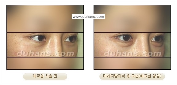 [두한성형외과 경쟁력 미세지방이식] - [눈밑 애교살을 위한 미세지방이식 1.] 관련 이미지 6