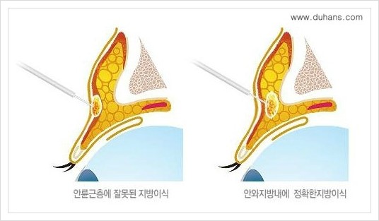 [두한성형외과 경쟁력 눈밑성형] - [다크써클 + 눈위 지방이식 콤비 프로그램] 관련 이미지 5