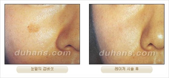 [두한성형외과 경쟁력 안전성형] - [최첨단 장비를 이용한 흉터, 점, 주근깨, 잡티, 문신제거 레이저 시술] 관련 이미지 22