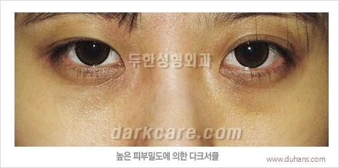[두한성형외과 경쟁력 눈밑성형] - [다크써클의 원인과 다크써클의 종류] 관련 이미지 12