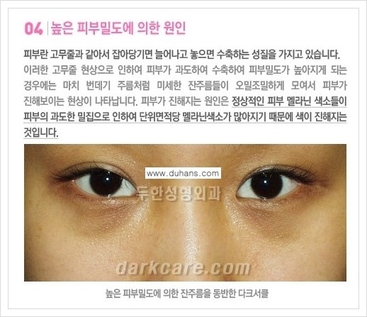 [두한성형외과 경쟁력 다크써클 교정] - [다크써클의 원인 안내] 관련 이미지 8