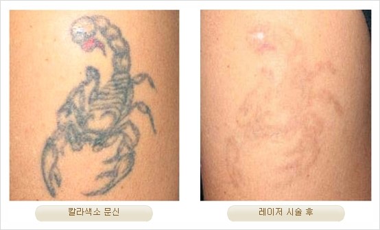 [두한성형외과 경쟁력 안전성형] - [최첨단 장비를 이용한 흉터, 점, 주근깨, 잡티, 문신제거 레이저 시술] 관련 이미지 27