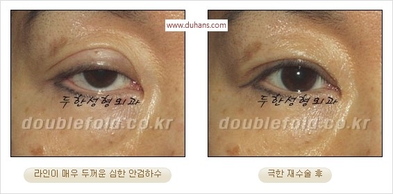[두한성형외과 경쟁력 쌍꺼풀 재수술] - [두꺼운 라인을 교정하는 극한 재수술(Extreme Rroperation)] 관련 이미지 21