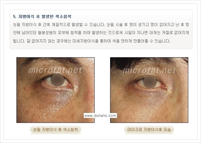 [두한성형외과 경쟁력 지방이식] - [지방이식 부작용 교정 안내 2.] 관련 이미지 12