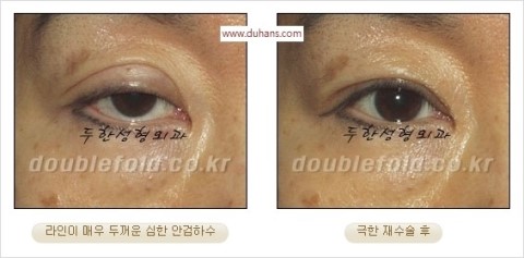 ​[두한성형외과 눈재수술] - [앞트임복원, 뒤트임복원, 쌍꺼풀복원] 관련 이미지 38