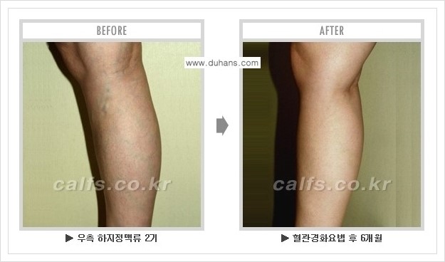 [두한성형외과 경쟁력 정맥류 치료] - [하지정맥류 사진 자료 안내 1.] 관련 이미지 2