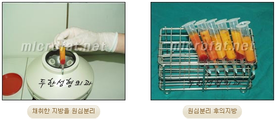 [Duhan Plastic Surgery Facial Fat Grafting] - [Fat Grafting Rhinoplasty] image 5