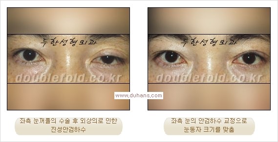 [두한성형외과 경쟁력 쌍꺼풀 재수술, 극한 눈재수술] - [안검하수(졸린 눈매)의 종류 안내] 관련 이미지 5