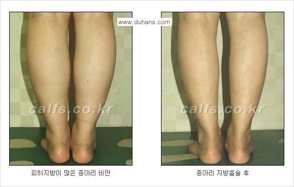 [두한성형외과 경쟁력 멀티종아리성형] - [지방흡입이 필요한 종아리 비만 안내] 관련 이미지 5
