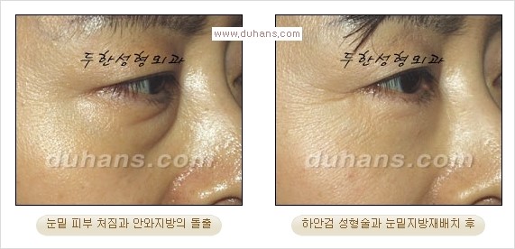 [두한성형외과 경쟁력 다크써클 교정] - [젊어 보이면서 개선된 인상을 주는 하안검 성형술] 관련 이미지 20
