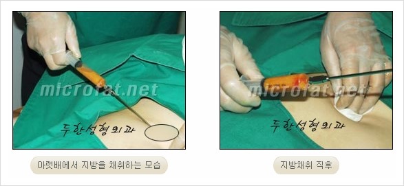 [두한성형외과 경쟁력 안티에이징 동안성형] - [주름이 깊은 푹~ 꺼진 입가 팔자주름 안녕!] 관련 이미지 10