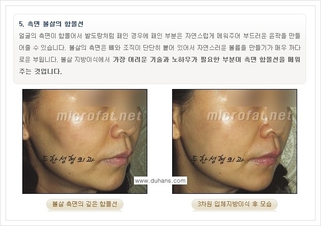 [두한성형외과 경쟁력 볼살지방이식] - [사각턱의 경우, 측면 볼살의 함몰선, 안면비대칭, 남성 야윈볼살 안내] 관련 이미지 3