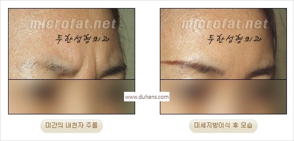 [두한성형외과 경쟁력 동안성형 리더] - ​[미간주름, 이마주름, 안검성형, 이마거상술, 눈썹거상술] 관련 이미지 10