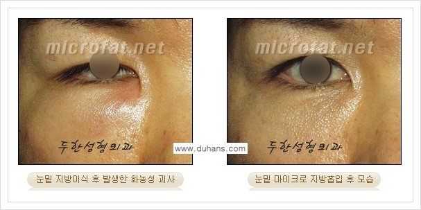 [두한성형외과 겨울엔 지방흡입을] - [볼살, 눈밑, 턱선의 초음파 미세지방흡입 2.] 관련 이미지 3