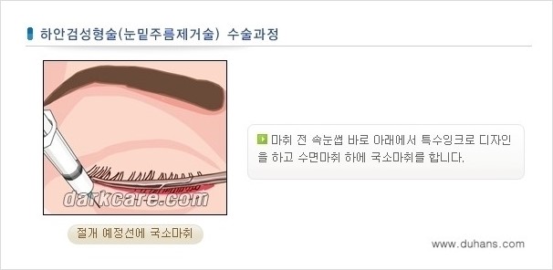[두한성형외과 경쟁력 다크써클 교정] - [젊어 보이면서 개선된 인상을 주는 하안검 성형술] 관련 이미지 4