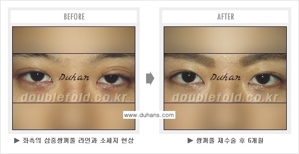 [두한성형외과 NO.1 쌍꺼풀 재수술, 극한 재수술] - [안검하수 교정이 불가능할 경우의 문제점 해결 안내] 관련 이미지 5
