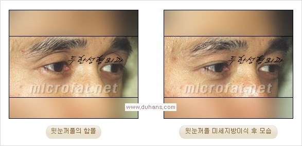 [두한성형외과 Dr. 컬럼] - [눈꺼풀의 지방이식] 관련 이미지 12