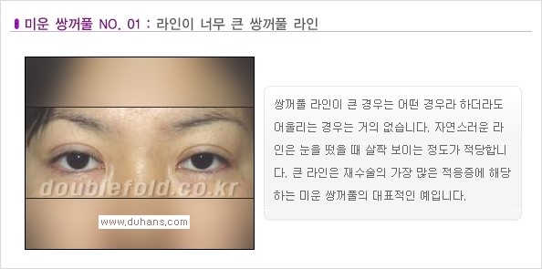 [두한성형외과 경쟁력 눈성형] - [나에게 맞는 맞춤 쌍꺼풀 찾기] 관련 이미지 1