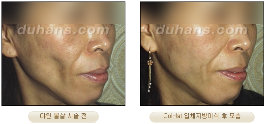[Duhan Plastic Surgery Facial Autologous Fat Grafting] - [Fat Grafting Guide] image 29