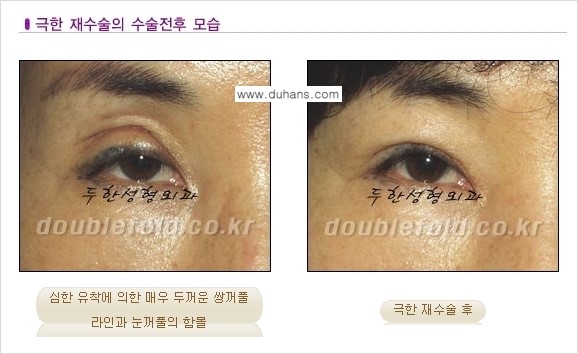 [두한성형외과 경쟁력 쌍꺼풀 재수술] - [망가진 쌍꺼풀 라인을 교정하는 극한재수술 ①] 관련 이미지 6