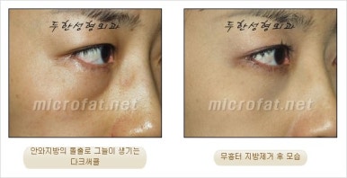 두한성형외과 눈밑수술 - 다크서클 수술 전후 관리 안내 관련 이미지 78