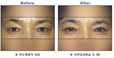 [Duhan Plastic Surgery Blepharoplasty] - [Upper Eyelid Surgery for a Younger-Looking Eye Area] image 10
