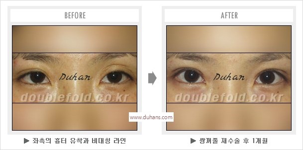 [두한성형외과 경쟁력 눈성형] - [나에게 맞는 어울리는 쌍꺼풀 라인] 관련 이미지 51