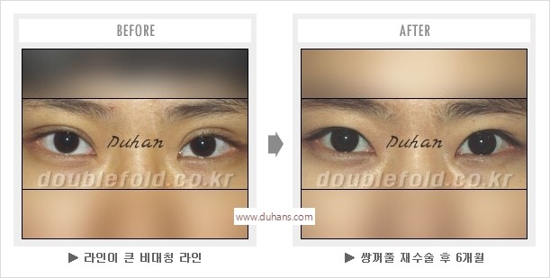 [두한성형외과 경쟁력 눈성형] - [나에게 맞는 어울리는 쌍꺼풀 라인] 관련 이미지 43