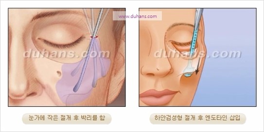 [두한성형외과 주름성형] - [주름교정술 - 강력한 리프팅 파워 엔도타인 리프팅 ] 관련 이미지 34