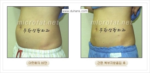 [두한성형외과 경쟁력 바디성형] - [하복부, 팔뚝, 허리선, 허벅지, 엉덩이 간편지방흡입술] 관련 이미지 21