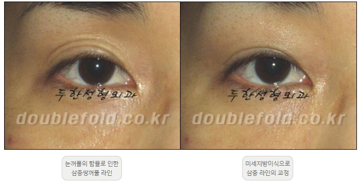 [Double Eyelid Surgery Duhan Plastic Surgery] - [Revision Methods] image 27