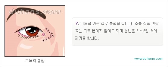[두한성형외과 경쟁력 눈성형] - [몽고주름 제거수술, 앞트임 수술 안내] 관련 이미지 13