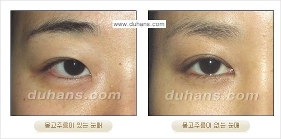 ​[두한성형외과 경쟁력 쌍꺼풀 재수술] - [아름다운 쌍꺼풀 선의 기준과 쌍꺼풀 재수술시 검사와 테스트 안내] 관련 이미지 3