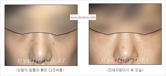 [두한성형외과 경쟁력 눈밑성형] - [눈밑 다크써클 수술 방법] 관련 이미지 14